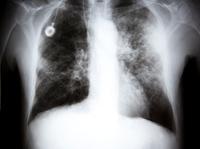 Some images of lung cancer are clear cut. But in many others, a nodule on the screen turns out not to be cancer at all. Some images of lung cancer are clear cut. But in many others, a nodule on the screen turns out not to be cancer at all.