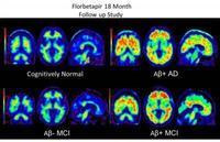 Brain scans using Amyvid dye to highlight beta-amyloid plaques in the brain. Clockwise from top left: a cognitively normal subject; an amyloid-positive patient with Alzheimer's disease; a patient with mild cognitive impairment who progressed to dementia d Brain scans using Amyvid dye to highlight beta-amyloid plaques in the brain. Clockwise from top left: a cognitively normal subject; an amyloid-positive patient with Alzheimer's disease; a patient with mild cognitive impairment who progressed to dementia d
