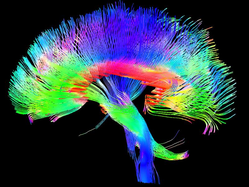 A colored 3-D MRI scan of the brain's white matter pathways traces connections between cells in the cerebrum and the brainstem. A colored 3-D MRI scan of the brain's white matter pathways traces connections between cells in the cerebrum and the brainstem.