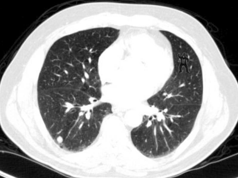 Notice anything unusual about this lung scan? Harvard researchers found that 83 percent of radiologists didn't notice the gorilla in the top right portion of this image. Notice anything unusual about this lung scan? Harvard researchers found that 83 percent of radiologists didn't notice the gorilla in the top right portion of this image.