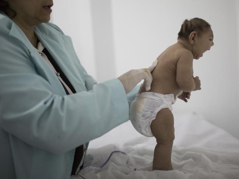 Two-month-old Lara, who was born with microcephaly, is examined by a neurologist at the Pedro I hospital in Campina Grande, Paraiba state, Brazil, on Feb. 12. Two-month-old Lara, who was born with microcephaly, is examined by a neurologist at the Pedro I hospital in Campina Grande, Paraiba state, Brazil, on Feb. 12.