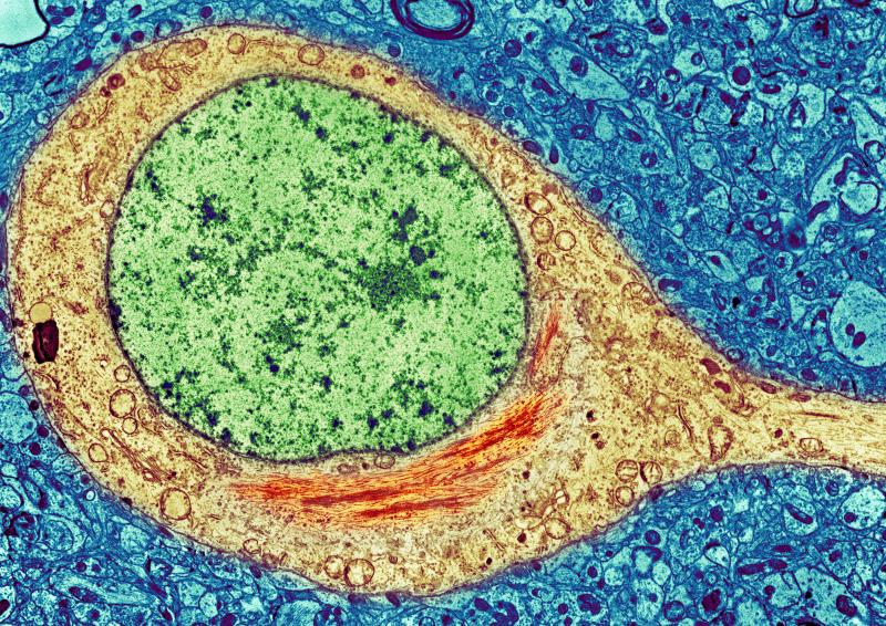 A colorized image of a brain cell from an Alzheimer's patient shows a neurofibrillary tangle (red) inside the cytoplasm (yellow) of the cell. The tangles consist primarily of a protein called tau. A colorized image of a brain cell from an Alzheimer's patient shows a neurofibrillary tangle (red) inside the cytoplasm (yellow) of the cell. The tangles consist primarily of a protein called tau.