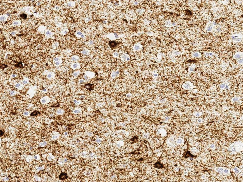 This image shows the buildup of toxic tau proteins in the medial temporal gyrus of a human brain. Though some drugs can now remove these proteins, that hasn't seemed to ease Alzheimer's symptoms. It's time to look more deeply into how the cells work, scie This image shows the buildup of toxic tau proteins in the medial temporal gyrus of a human brain. Though some drugs can now remove these proteins, that hasn't seemed to ease Alzheimer's symptoms. It's time to look more deeply into how the cells work, scie