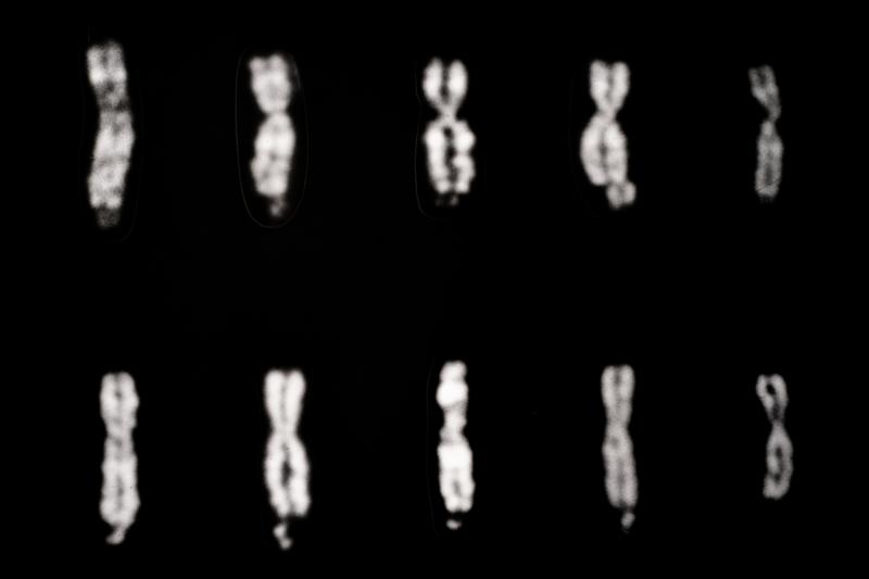Fragile X syndrome involves changes in the X chromosome, as pictured in the four columns of chromosomes starting on the left. The fifth column, on the far right, shows two normal X chromosomes. Fragile X syndrome involves changes in the X chromosome, as pictured in the four columns of chromosomes starting on the left. The fifth column, on the far right, shows two normal X chromosomes.