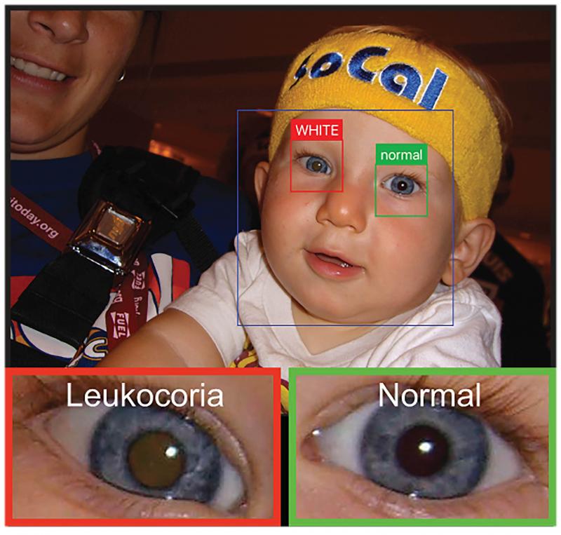 An app uses a smartphone camera to detect leukocoria, a pale reflection from the back of the eye. It can be an early sign of disease. Here it appears light brown compared the healthy eye. An app uses a smartphone camera to detect leukocoria, a pale reflection from the back of the eye. It can be an early sign of disease. Here it appears light brown compared the healthy eye.