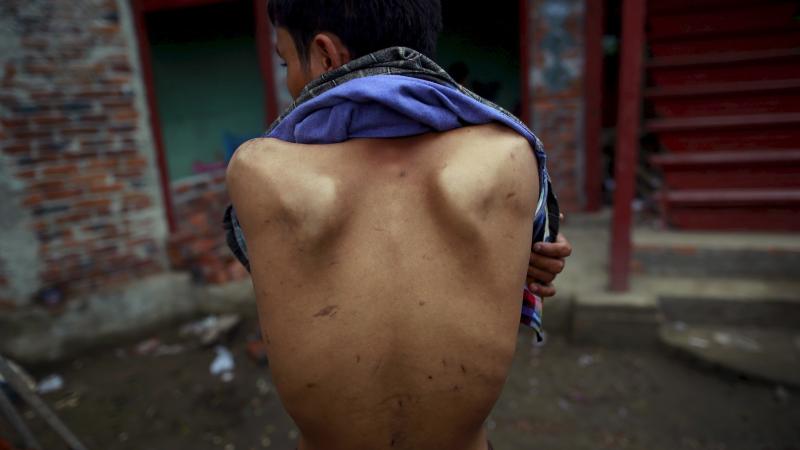 A 16-year-old refugee shows the scars he received while held on a human trafficking boat. Evidence of physical violence like this lends credence to the stories of those seeking asylum in the U.S. It's Dr. Katherine McKenzie's job to evaluate it. A 16-year-old refugee shows the scars he received while held on a human trafficking boat. Evidence of physical violence like this lends credence to the stories of those seeking asylum in the U.S. It's Dr. Katherine McKenzie's job to evaluate it.