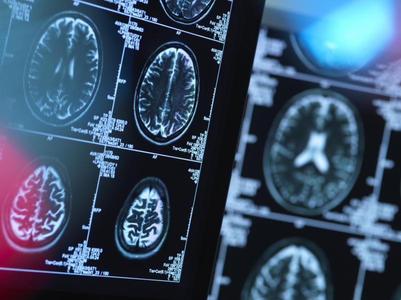 New research finds that previous studies of mental illness using brain scans may be too small for the results to be reliable. New research finds that previous studies of mental illness using brain scans may be too small for the results to be reliable.