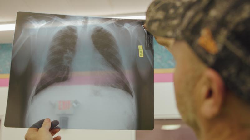 Coal miner Nick Stiltner reviews an X-ray of his lungs showing black lung disease at the Stone Mountain Clinic in Grundy, Va. Coal miner Nick Stiltner reviews an X-ray of his lungs showing black lung disease at the Stone Mountain Clinic in Grundy, Va.