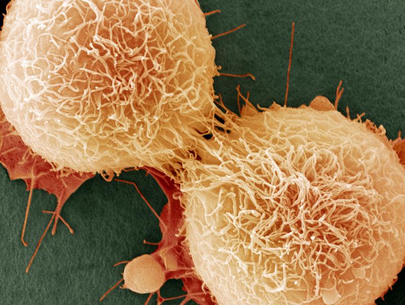 Nearly two-thirds of cell mutations that cause cancer are caused by random error, a study found. Nearly two-thirds of cell mutations that cause cancer are caused by random error, a study found.