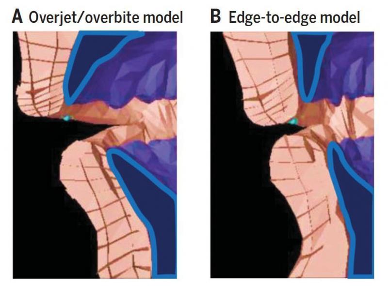 A biomechanical model of producing an "f" sound with an overbite (left) compared with an edge-to-edge bite (right). Some linguists are arguing that the advent of softer food thousands of years ago led to changes in biting patterns and, eventually, to more A biomechanical model of producing an "f" sound with an overbite (left) compared with an edge-to-edge bite (right). Some linguists are arguing that the advent of softer food thousands of years ago led to changes in biting patterns and, eventually, to more
