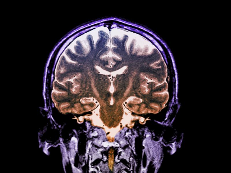 Patients with a fast-progressing form of ALS who got daily doses of an experimental two-drug combination called AMX0035 scored higher on a standard measure of function than patients who didn't get the drug. Patients with a fast-progressing form of ALS who got daily doses of an experimental two-drug combination called AMX0035 scored higher on a standard measure of function than patients who didn't get the drug.