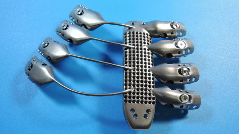 Engineers made the implant with a metallic 3-D printer that melts titanium powder. Engineers made the implant with a metallic 3-D printer that melts titanium powder.