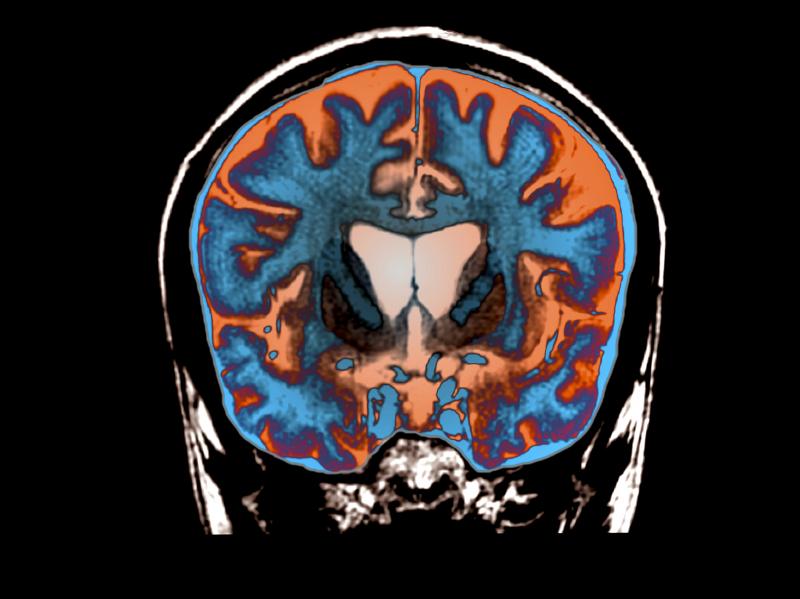 An MRI scan shows signs of atrophy in the brain of a patient with Huntington's disease. An MRI scan shows signs of atrophy in the brain of a patient with Huntington's disease.