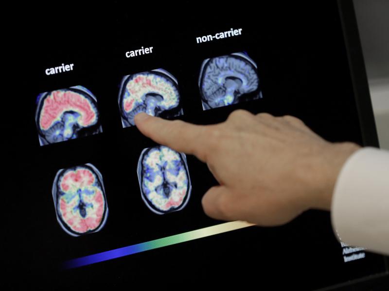 Dr. William Burke reviews a PET brain scan at Banner Alzheimer's Institute in Phoenix in 2018. An experimental Alzheimer's drug from Biogen and Eisai is on the verge of a Food and Drug Administration decision. Dr. William Burke reviews a PET brain scan at Banner Alzheimer's Institute in Phoenix in 2018. An experimental Alzheimer's drug from Biogen and Eisai is on the verge of a Food and Drug Administration decision.