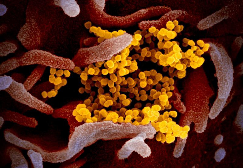 This colorized transmission electron micrograph image shows SARS-CoV-2, the coronavirus that causes the disease COVID-19. This specimen was isolated from a patient in the United States. Particles of the virus (yellow) are emerging from the surface of cell This colorized transmission electron micrograph image shows SARS-CoV-2, the coronavirus that causes the disease COVID-19. This specimen was isolated from a patient in the United States. Particles of the virus (yellow) are emerging from the surface of cell