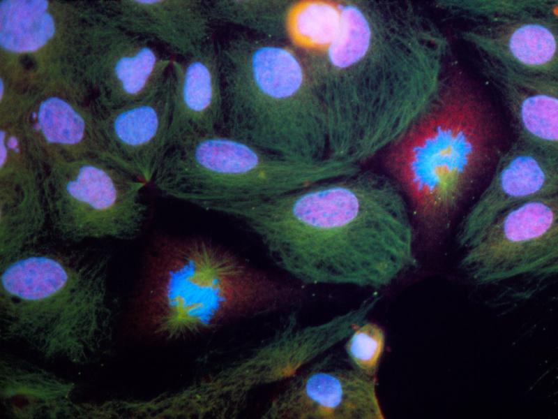 Immunofluorescent light micrograph of human colon cancer cells, highlighting the nucleus of each cell in pink. U.S. doctors have been seeing an increase in colorectal cancer cases — and deaths — among people under age 50. Immunofluorescent light micrograph of human colon cancer cells, highlighting the nucleus of each cell in pink. U.S. doctors have been seeing an increase in colorectal cancer cases — and deaths — among people under age 50.