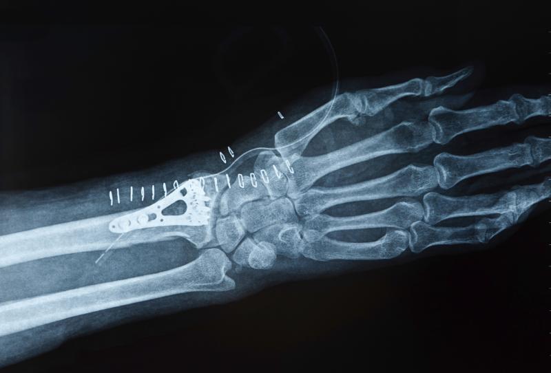 A man who breaks a wrist after age 50 is more likely to die prematurely than a woman with the same injury. A man who breaks a wrist after age 50 is more likely to die prematurely than a woman with the same injury.