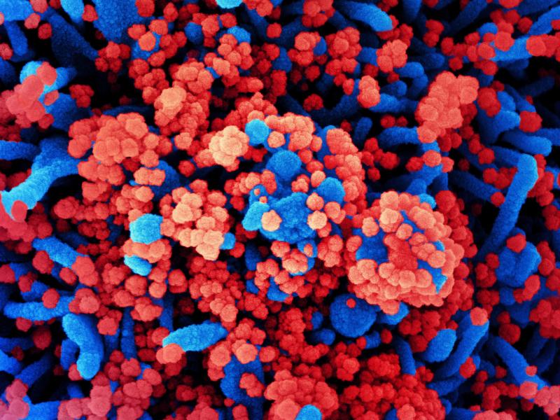 SARS-CoV-2 virus particles, shown in red, have heavily infected a cell in this colorized scanning electron micrograph. SARS-CoV-2 is the virus that causes COVID-19. SARS-CoV-2 virus particles, shown in red, have heavily infected a cell in this colorized scanning electron micrograph. SARS-CoV-2 is the virus that causes COVID-19.