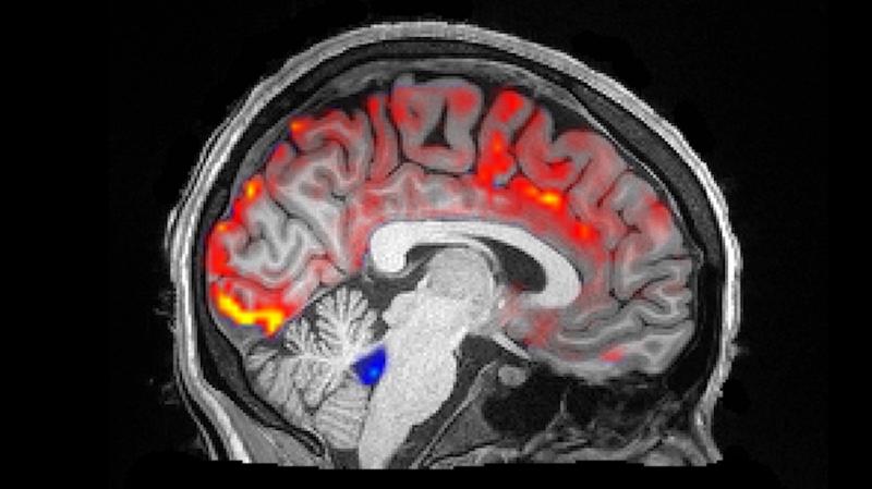 During deep sleep, waves of cerebrospinal fluid (blue) coincide with temporary decreases in blood flow (red). Less blood in the brain means more room for the fluid to carry away toxins, including those associated with Alzheimer's disease. During deep sleep, waves of cerebrospinal fluid (blue) coincide with temporary decreases in blood flow (red). Less blood in the brain means more room for the fluid to carry away toxins, including those associated with Alzheimer's disease.