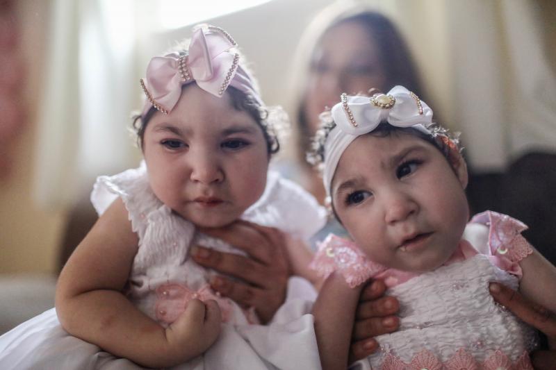 Twins Heloisa (left) and Heloa Barbosa, both born with microcephaly, had a one-year birthday party on April 16 in Areia, Brazil. Their mother says she contracted the Zika virus during pregnancy. Twins Heloisa (left) and Heloa Barbosa, both born with microcephaly, had a one-year birthday party on April 16 in Areia, Brazil. Their mother says she contracted the Zika virus during pregnancy.