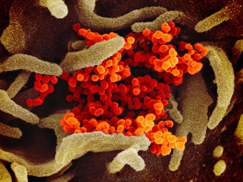 In this image from a scanning electron microscope, the new coronavirus is in orange. In this image from a scanning electron microscope, the new coronavirus is in orange.