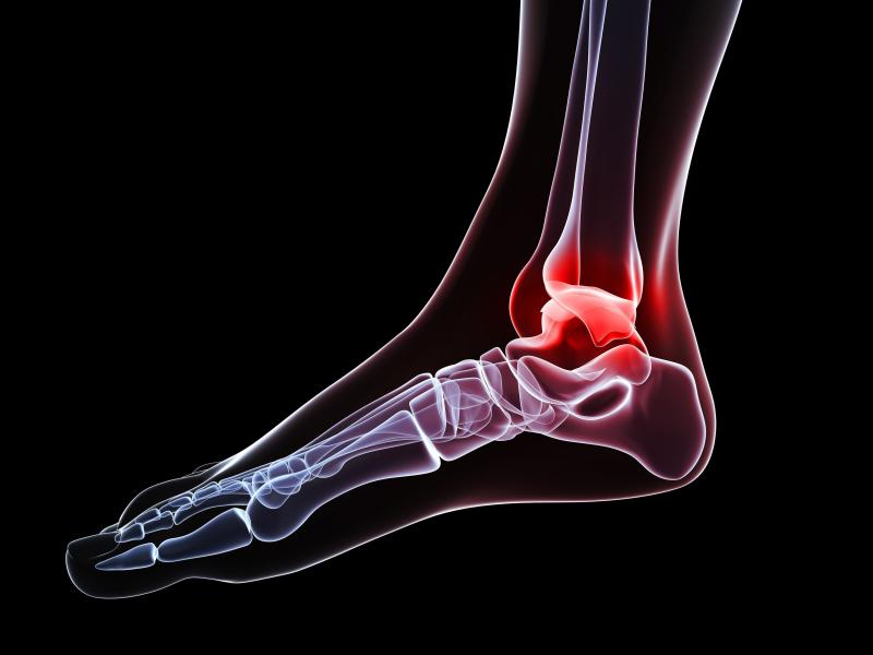 Ankle pain, conceptual computer artwork. Ankle pain, conceptual computer artwork.