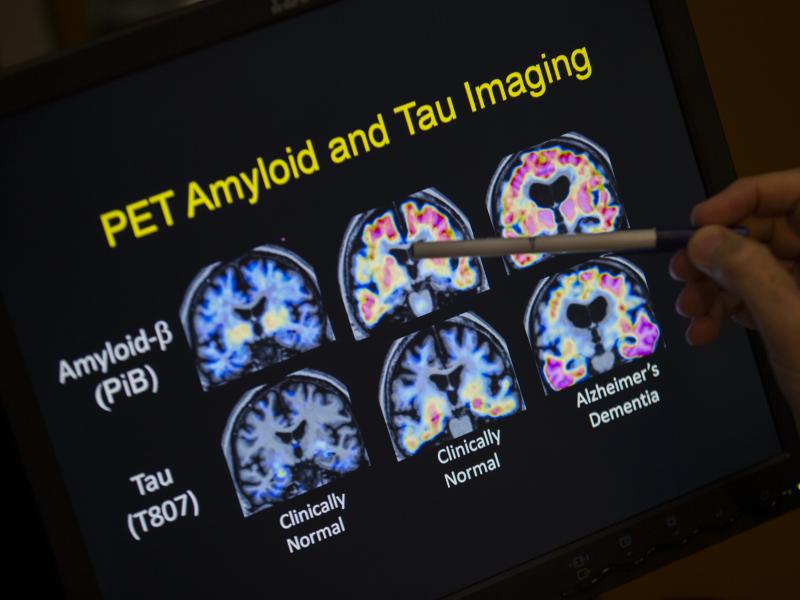 In a May 19, 2015 file photo, R. Scott Turner, Professor of Neurology and Director of the Memory Disorder Center at Georgetown University Hospital, points to PET scan results that are part of a study on Alzheimer's disease at Georgetown University Hospita In a May 19, 2015 file photo, R. Scott Turner, Professor of Neurology and Director of the Memory Disorder Center at Georgetown University Hospital, points to PET scan results that are part of a study on Alzheimer's disease at Georgetown University Hospita