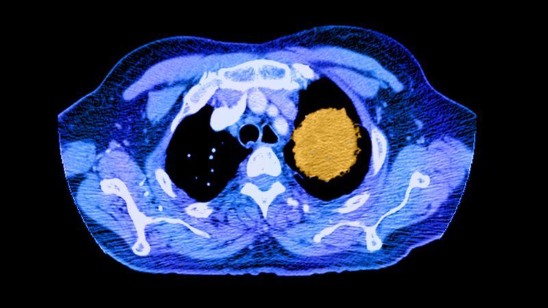 A color-enhanced spiral CT image of the chest shows a large cancerous mass (in yellow) in the left upper lobe. A color-enhanced spiral CT image of the chest shows a large cancerous mass (in yellow) in the left upper lobe.
