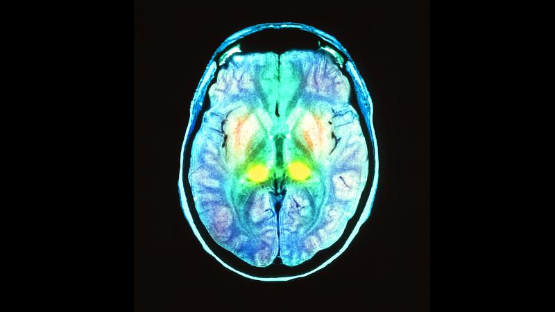 Colored brain scan of a 17-year-old boy with mad cow disease. The bright yellow spots are a sign that the thalamus is damaged by diseased proteins. Colored brain scan of a 17-year-old boy with mad cow disease. The bright yellow spots are a sign that the thalamus is damaged by diseased proteins.