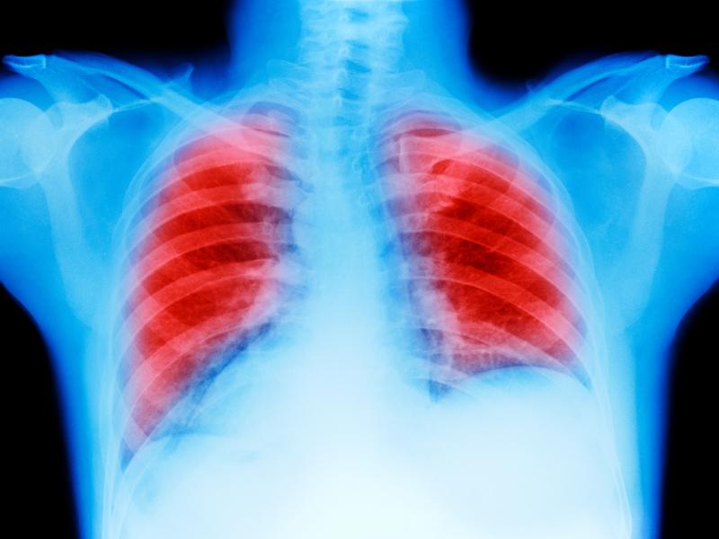 A combination of an immunotherapy drug from Merck and standard chemotherapy led to improved survival for cancer patients. A combination of an immunotherapy drug from Merck and standard chemotherapy led to improved survival for cancer patients.