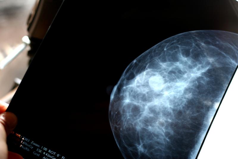 Mammogram Mammogram