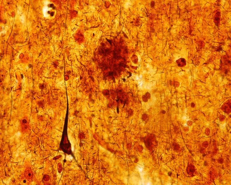 This light micrograph from the brain of someone who died with Alzheimer's disease shows the plaques and neurofibrillary tangles that are typical of the disease. A glitch that prevents healthy cell structures from transitioning from one phase to the next m This light micrograph from the brain of someone who died with Alzheimer's disease shows the plaques and neurofibrillary tangles that are typical of the disease. A glitch that prevents healthy cell structures from transitioning from one phase to the next m