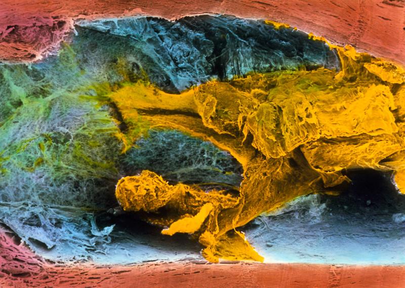 Fatty plaque (shown here in yellow) blocks about 60 percent of this coronary artery's width. The increasing thickness of artery walls is just one factor that can increase vulnerability to a heart attack or stroke. Fatty plaque (shown here in yellow) blocks about 60 percent of this coronary artery's width. The increasing thickness of artery walls is just one factor that can increase vulnerability to a heart attack or stroke.