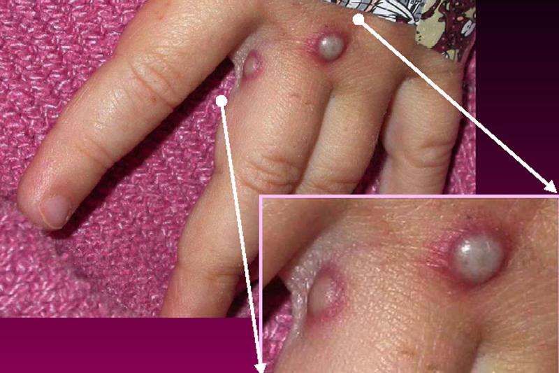 Symptoms of the monkeypox virus are shown on a patient's hand, from a 2003 case in the United States. In most instances, the disease causes fever and painful, pus-filled blisters. New cases in the United Kingdom, Spain and Portugal are spreading possibly Symptoms of the monkeypox virus are shown on a patient's hand, from a 2003 case in the United States. In most instances, the disease causes fever and painful, pus-filled blisters. New cases in the United Kingdom, Spain and Portugal are spreading possibly