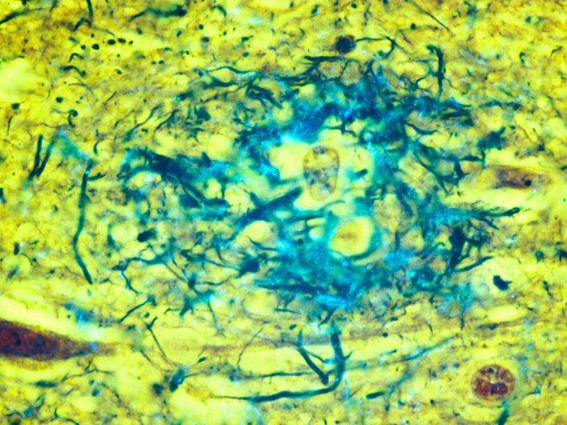 Plaques located in the gray matter of the brain are key indicators of Alzheimer's disease. Plaques located in the gray matter of the brain are key indicators of Alzheimer's disease.