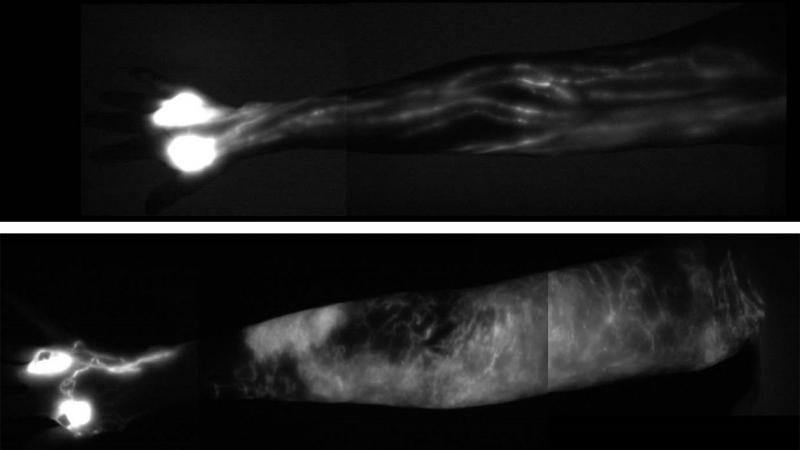 The image of a normal upper arm (top) shows the delicate network of healthy lymph vessels. In the lower image of a patient with lymphedema, a collection of lymph fluid, in white, has made the arm swell. The image of a normal upper arm (top) shows the delicate network of healthy lymph vessels. In the lower image of a patient with lymphedema, a collection of lymph fluid, in white, has made the arm swell.