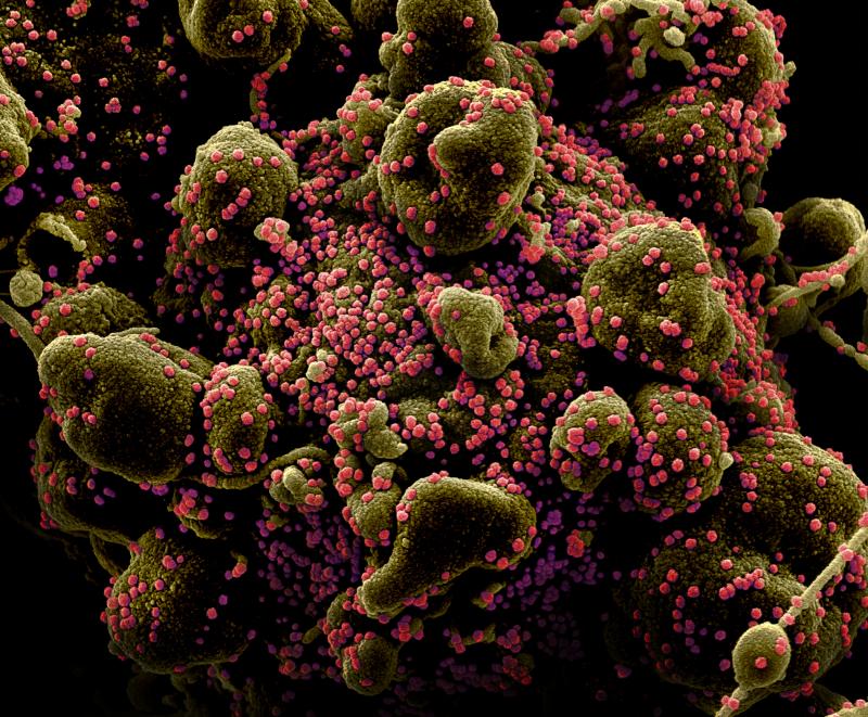 A colorized image of cells from a patient infected with the coronavirus SARS-CoV-2. The virus particles are colored pink. The image was captured from a scanning electron micrograph. A colorized image of cells from a patient infected with the coronavirus SARS-CoV-2. The virus particles are colored pink. The image was captured from a scanning electron micrograph.