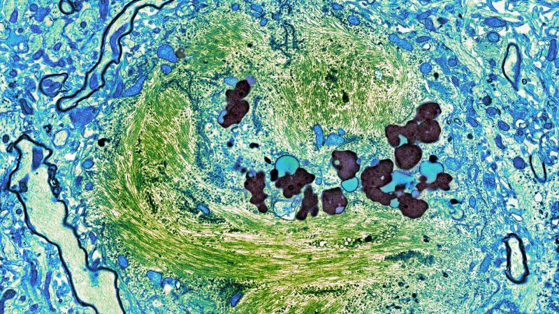 A tangle of protein (green) in this scanning electron micrograph of a brain cell of an Alzheimer's patient lies within the cytoplasm (blue) of the cell. The tangle consists of clumps of a toxic form of tau. A tangle of protein (green) in this scanning electron micrograph of a brain cell of an Alzheimer's patient lies within the cytoplasm (blue) of the cell. The tangle consists of clumps of a toxic form of tau.