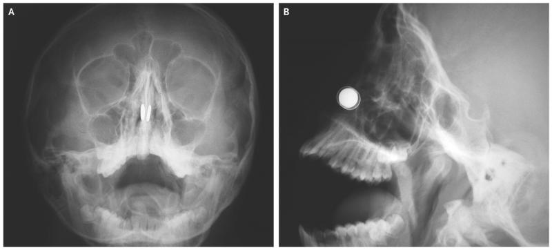 An 11-year-old boy put small magnets up both nostrils, then couldn't figure out how to get them out. These X-rays tell the tale. An 11-year-old boy put small magnets up both nostrils, then couldn't figure out how to get them out. These X-rays tell the tale.