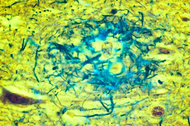 Diseased brain tissue from an Alzheimer's patient showing amyloid plaques (in blue) located in the gray matter of the brain. Diseased brain tissue from an Alzheimer's patient showing amyloid plaques (in blue) located in the gray matter of the brain.