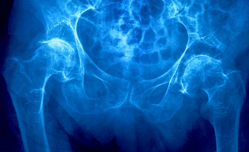 Osteoporosis specialists are considering wider use of a drug to strengthen bones in elderly women. Osteoporosis specialists are considering wider use of a drug to strengthen bones in elderly women.