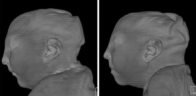 Twin girls infected with Zika at nine weeks of gestation. Both were born with extremely small heads, shrunken spinal cords and extra folds of skin around the skull. Scientists think this extra skin forms when the skull collapses onto itself after the brai Twin girls infected with Zika at nine weeks of gestation. Both were born with extremely small heads, shrunken spinal cords and extra folds of skin around the skull. Scientists think this extra skin forms when the skull collapses onto itself after the brai