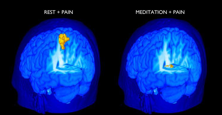 This scan illustrates activity in the primary somatosensory cortex. This area is highly active during pain and rest. But its activity level is far lower during meditation and pain. This scan illustrates activity in the primary somatosensory cortex. This area is highly active during pain and rest. But its activity level is far lower during meditation and pain.