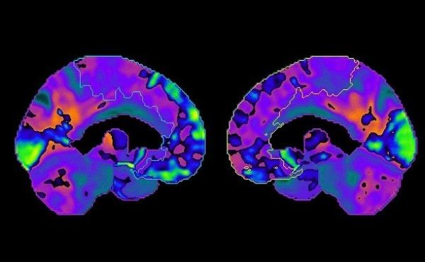 Dr. Jame Abraham used positron emission tomography, or PET, scans to understand differences in brain metabolism before and after chemotherapy. Dr. Jame Abraham used positron emission tomography, or PET, scans to understand differences in brain metabolism before and after chemotherapy.