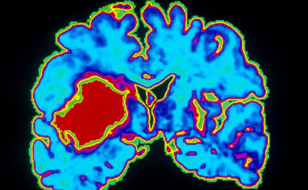 A computer-enhanced scan of a brain shows a hemorrhage due to hypertension. A computer-enhanced scan of a brain shows a hemorrhage due to hypertension.