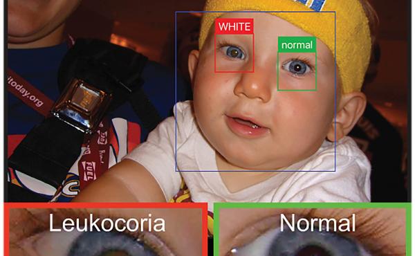 An app uses a smartphone camera to detect leukocoria, a pale reflection from the back of the eye. It can be an early sign of disease. Here it appears light brown compared the healthy eye. An app uses a smartphone camera to detect leukocoria, a pale reflection from the back of the eye. It can be an early sign of disease. Here it appears light brown compared the healthy eye.