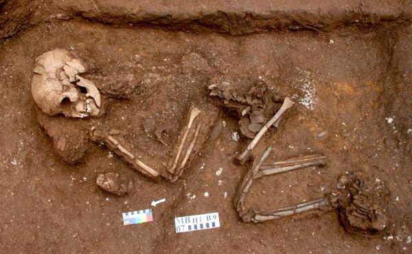 A skeleton found in Vietnam, dubbed Burial 9, was discovered in 2007. A closer look at his bones led to a diagnosis of rare genetic syndrome that often leads to paralysis. "From the bones alone, we can say this person lived with a disease that required he A skeleton found in Vietnam, dubbed Burial 9, was discovered in 2007. A closer look at his bones led to a diagnosis of rare genetic syndrome that often leads to paralysis. "From the bones alone, we can say this person lived with a disease that required he