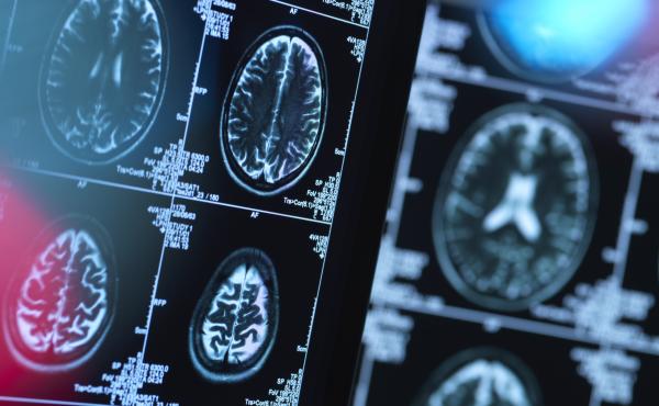 New research finds that previous studies of mental illness using brain scans may be too small for the results to be reliable. New research finds that previous studies of mental illness using brain scans may be too small for the results to be reliable.