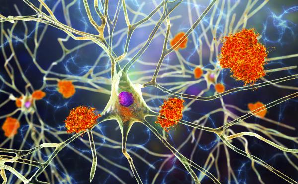 Amyloid plaques are characteristic features of Alzheimer's disease. The new drug Aduhelm is able to remove this sticky substance that builds up in the brains of patients with the disease, but many doctors are still skeptical of how well it really works. Amyloid plaques are characteristic features of Alzheimer's disease. The new drug Aduhelm is able to remove this sticky substance that builds up in the brains of patients with the disease, but many doctors are still skeptical of how well it really works.