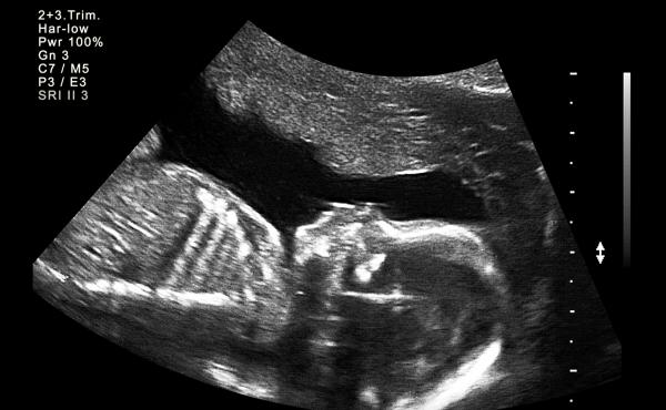 Ultrasound is often used for prenatal screening. It's just one of several prenatal screenings available to pregnant women. Ultrasound is often used for prenatal screening. It's just one of several prenatal screenings available to pregnant women.